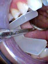 Load image into Gallery viewer, NU-BLOCK - 100 Disposable Mouth Props