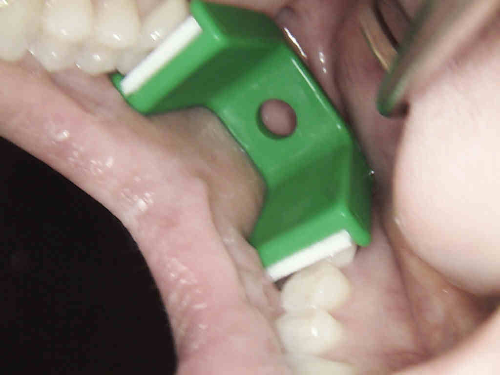 Disposable Dental Mouth Props - Adult Large Bite Blocks, 48 Pieces For Ortho/Piercing